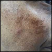 Hyperpigmentation Treatment in Ayurveda