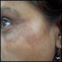 Hyperpigmentation Treatment in Ayurveda