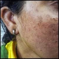 Hyperpigmentation Treatment in Ayurveda