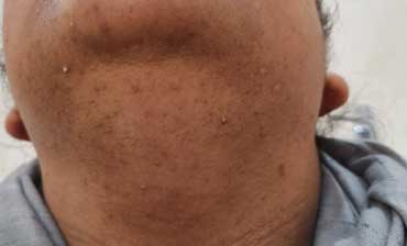 PCOS PCOD TREATMENT