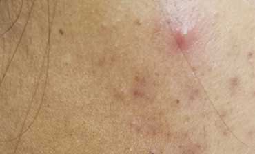 Acne(Pimples)