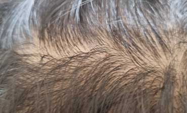 Hair Loss Treatments